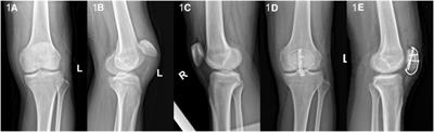 Treatment of proximal patellar tendon rupture with custom-made anchor-like plate and suture: cases report and literature review